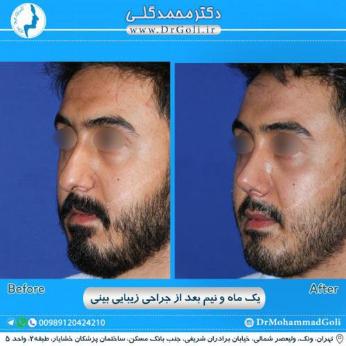 جراحی زیبایی بینی 244