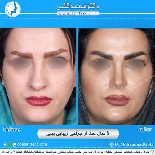 جراحی زیبایی بینی 245