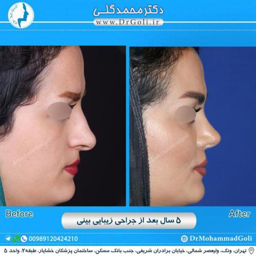 جراحی زیبایی بینی 246