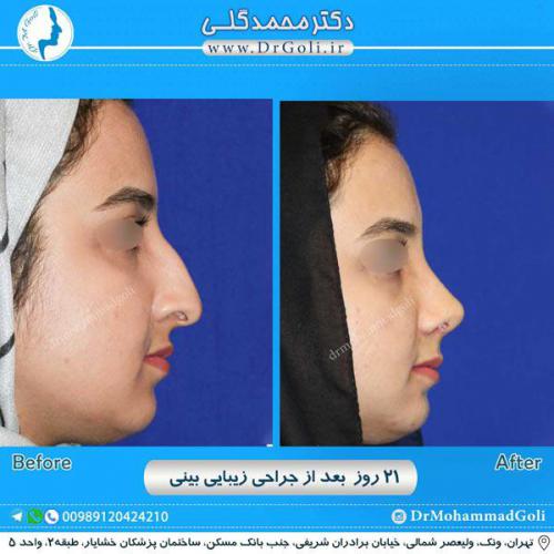 جراحی زیبایی بینی 248 (1)