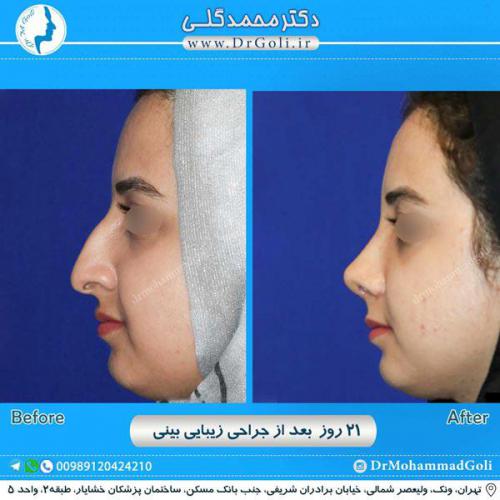 جراحی زیبایی بینی 249 (1)