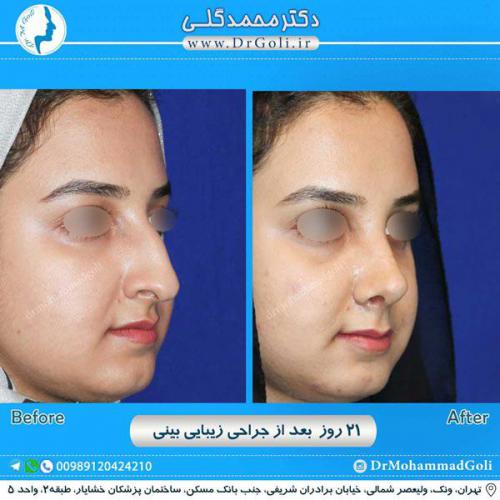 جراحی زیبایی بینی 250 (1) (1)