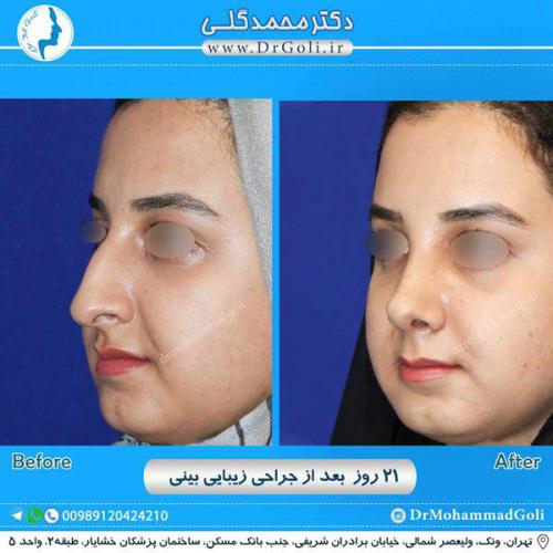 جراحی زیبایی بینی 251 (1) (1)