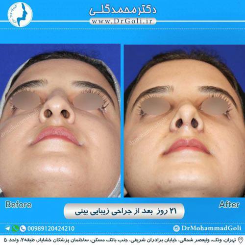 جراحی زیبایی بینی 252 (1) (1)