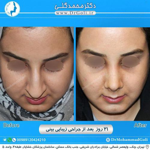 جراحی زیبایی بینی 253 (1)