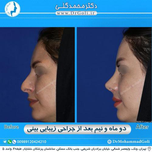 جراحی زیبایی بینی 278