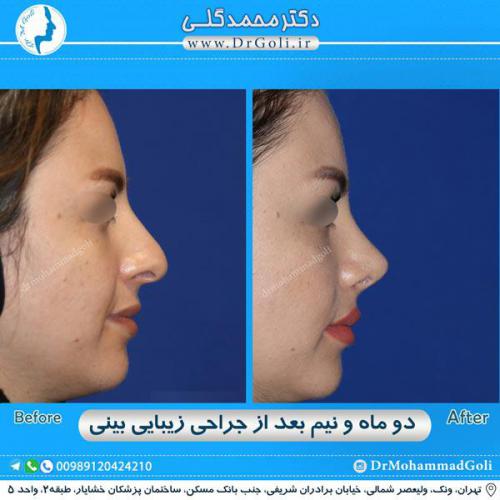جراحی زیبایی بینی 279