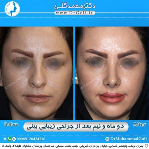 جراحی زیبایی بینی 280