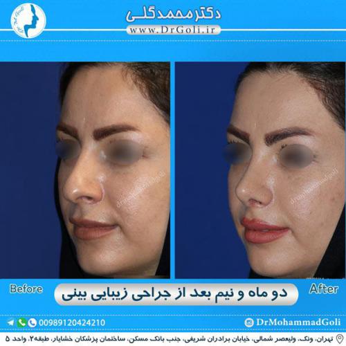 جراحی زیبایی بینی 281