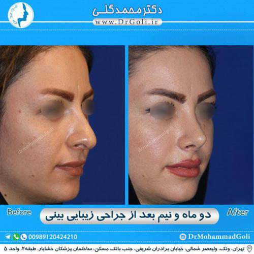 جراحی زیبایی بینی 282