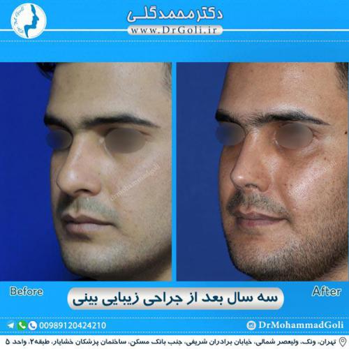 جراحی زیبایی بینی 283
