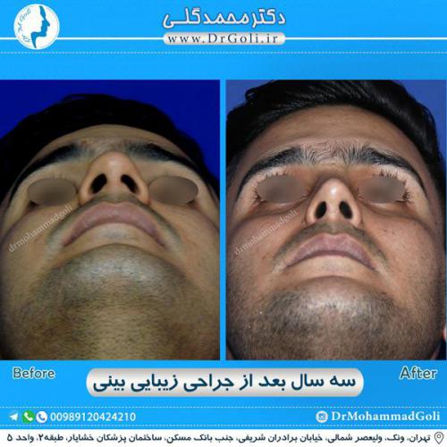 جراحی زیبایی بینی 284
