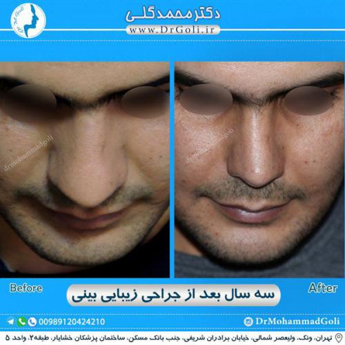 جراحی زیبایی بینی 285