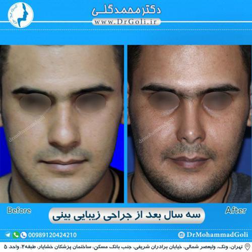 جراحی زیبایی بینی 286