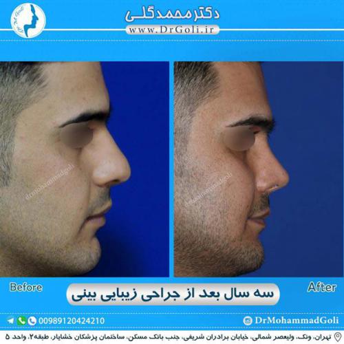 جراحی زیبایی بینی 287