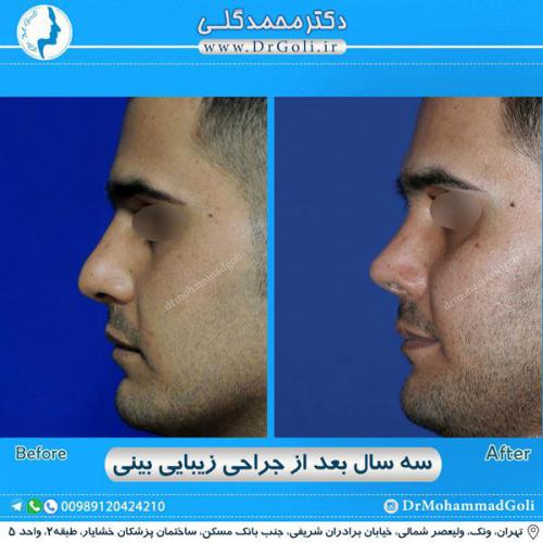 جراحی زیبایی بینی 288