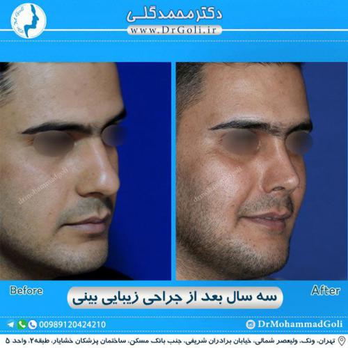 جراحی زیبایی بینی 289