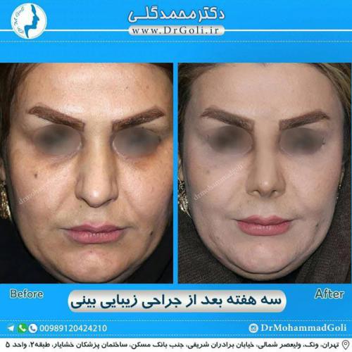 جراحی زیبایی بینی 290