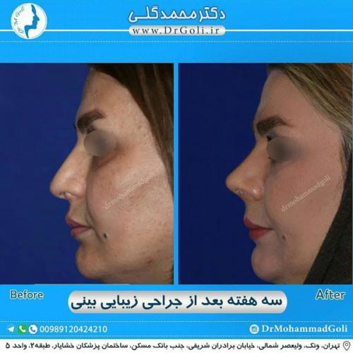 جراحی زیبایی بینی 291