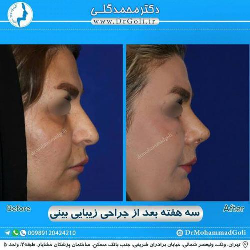 جراحی زیبایی بینی 292