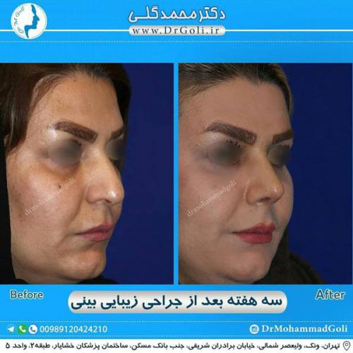 جراحی زیبایی بینی 293
