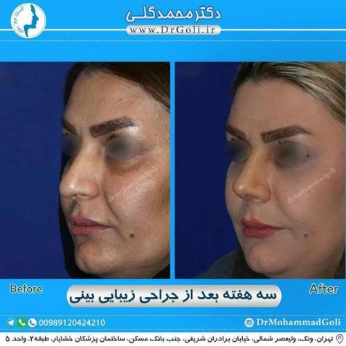 جراحی زیبایی بینی 294