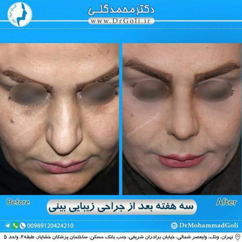 جراحی زیبایی بینی 295