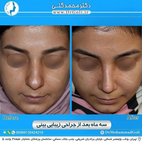 جراحی زیبایی بینی 317