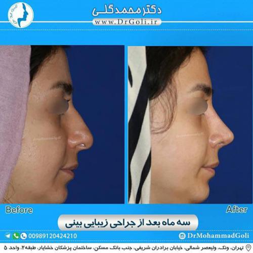جراحی زیبایی بینی 318