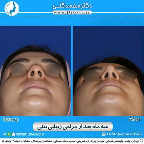 جراحی زیبایی بینی 319