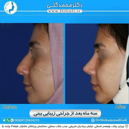 جراحی زیبایی بینی 320
