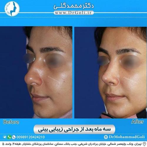 جراحی زیبایی بینی 321