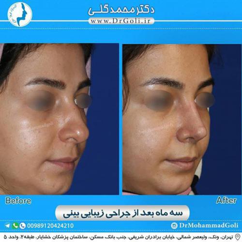 جراحی زیبایی بینی 322