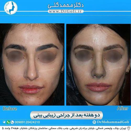 جراحی زیبایی بینی 323