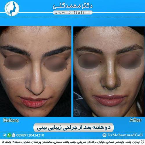 جراحی زیبایی بینی 324