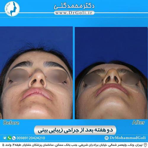 جراحی زیبایی بینی 325