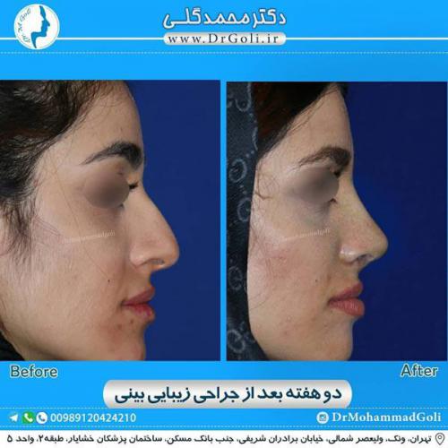 جراحی زیبایی بینی 326
