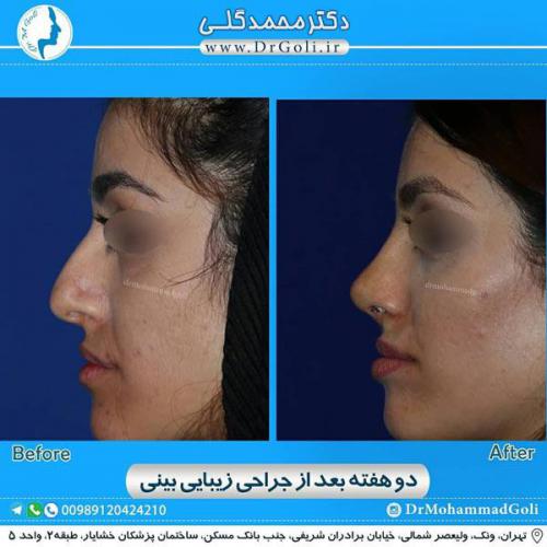 جراحی زیبایی بینی 327