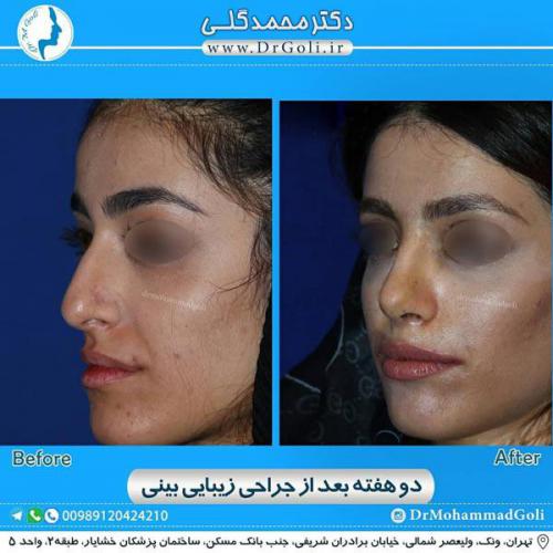 جراحی زیبایی بینی 328