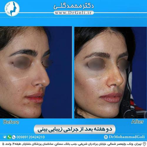 جراحی زیبایی بینی 329