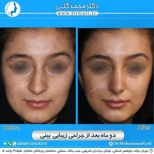 جراحی زیبایی بینی 330