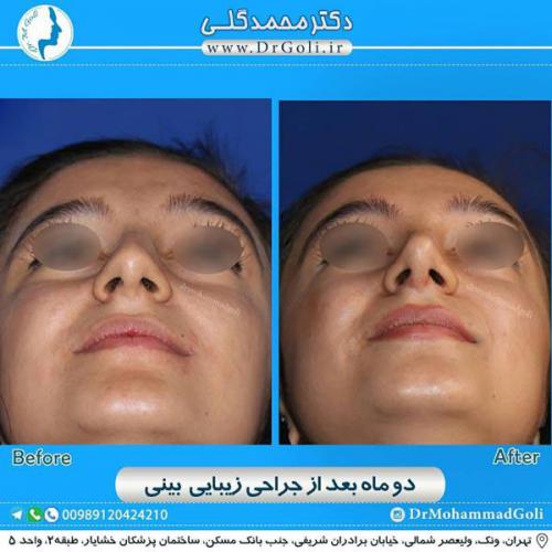 جراحی زیبایی بینی 331
