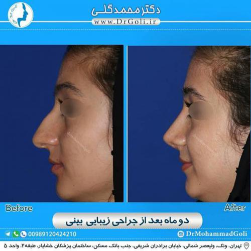 جراحی زیبایی بینی 332