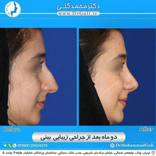 جراحی زیبایی بینی 333