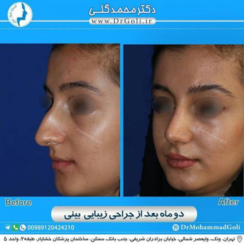 جراحی زیبایی بینی 334