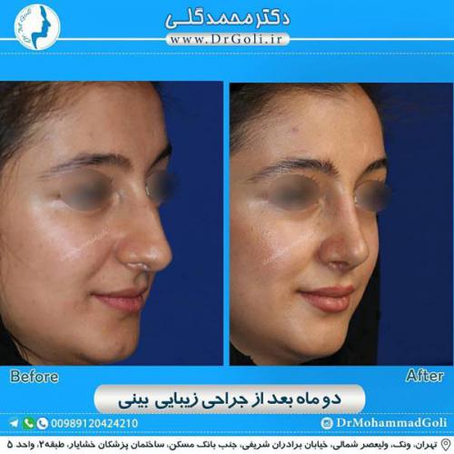 جراحی زیبایی بینی 335