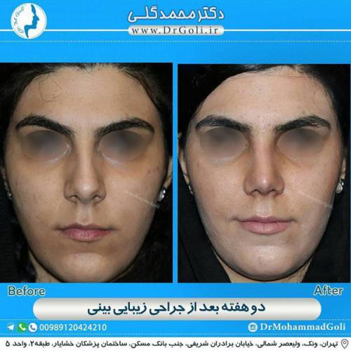 جراحی زیبایی بینی 336