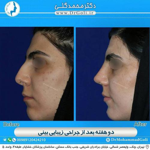 جراحی زیبایی بینی 337
