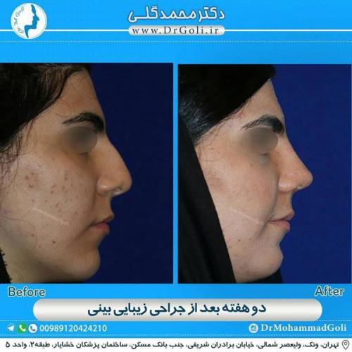 جراحی زیبایی بینی 338