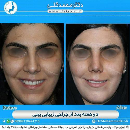جراحی زیبایی بینی 339
